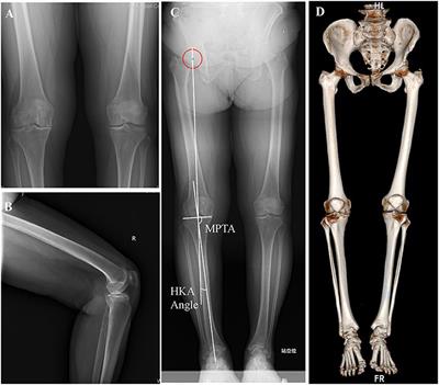 Mixed Reality Technology in Total Knee Arthroplasty: An Updated Review With a Preliminary Case Report